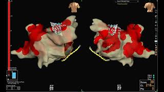 Impedance - Guided Pulseselect Contact Mapping (Ensite X)
