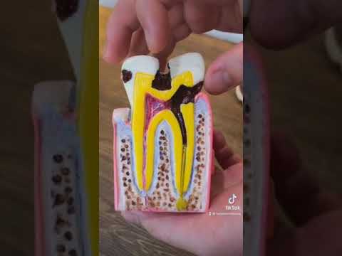 Video: Mengapa gigi manis terbakar?