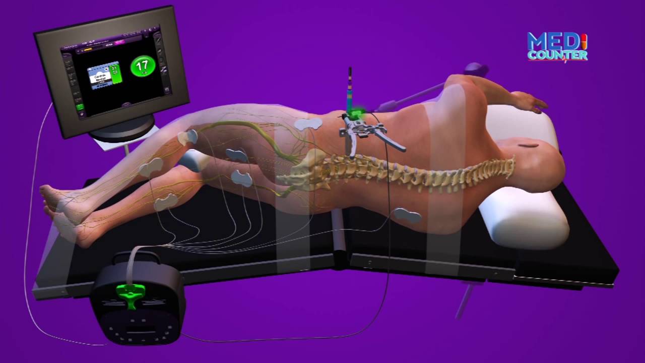 MEDICOUNTER EPS 8: MAUMIVU YA MGONGO