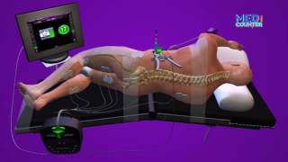 MEDICOUNTER EPS 8: MAUMIVU YA MGONGO