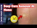 Deep corn Removal At Home [ 2022] Full Treatment By Miss Foot Fixer