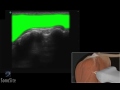 Dmo 3d chographie du tendon du biceps  chographe sonosite