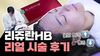 리쥬란HB 통증 / 효과 / 엠보 알아보기! (시술 과정)