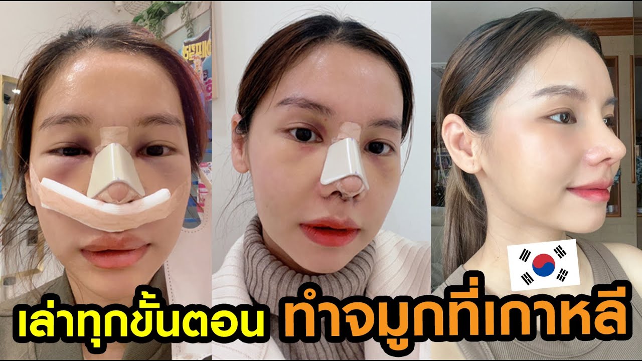 👃 เล่าทุกขั้นตอน แก้จมูกที่เกาหลี ✈️🇰🇷 - Youtube