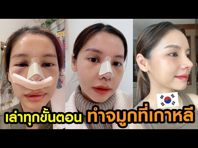 👃 เล่าทุกขั้นตอน แก้จมูกที่เกาหลี ✈️🇰🇷 - Youtube