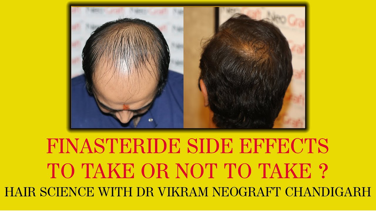 how common are finasteride side effects