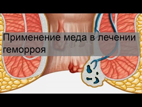 Применение меда в лечении геморроя