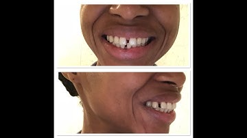 Invisalign for Gaps. My first Aligners