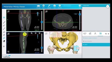 Performing Measurements and Providing Annotations in Mimics Viewer