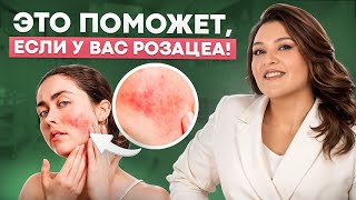 Что делать, если у вас РОЗАЦЕА? Лучшие средства и процедуры для улучшения кожи в этом видео!