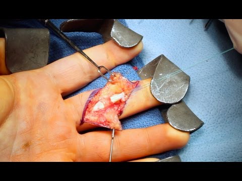 Live Surgery: Flexor Digitorum Profundus (FDP) Finger Tendon Repair