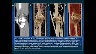The Role of CR in the Evaluation of Complex Vascular Injury of the Lower Extremities - Part 1