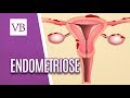 Endometriose - Você Bonita (21/03/19)