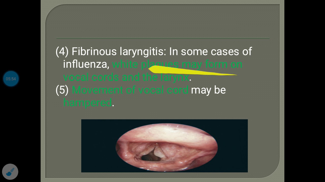 Laryngitis 