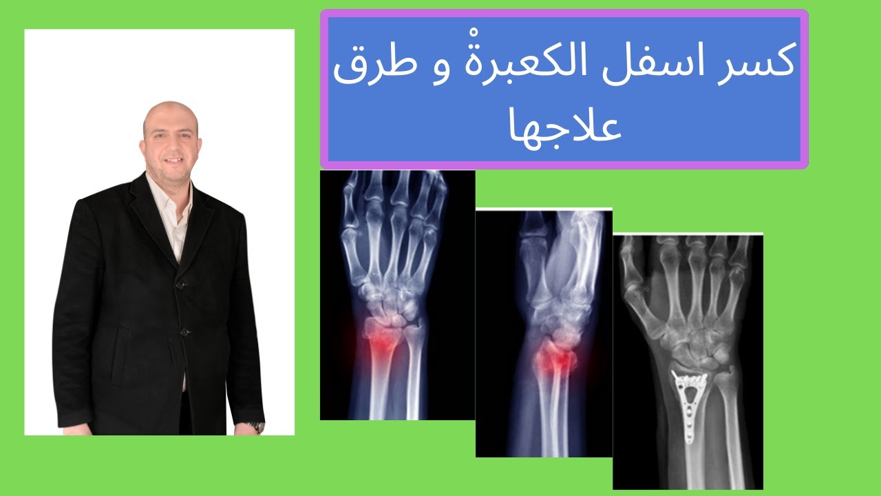 كسر اسفل الكعبرةْ و طرق علاجها للدكتولر احمد العطار