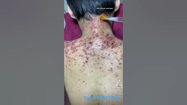 Back acne