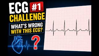 Famous ECG Challenge #1: Can You Spot the Abnormality? Wealth