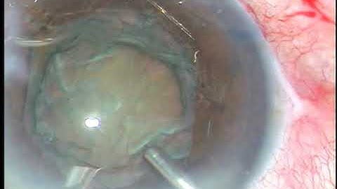 IOL displaces the B-HEX : How to avoid this?