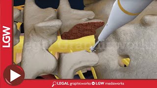 L5S1 Lumbar Discectomy and Fusion Surgery 3D animation