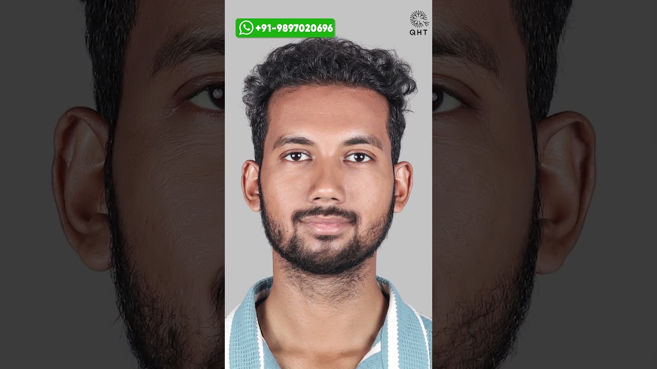 Remarkable Hair Transplant Results | Latest Fue Technique 