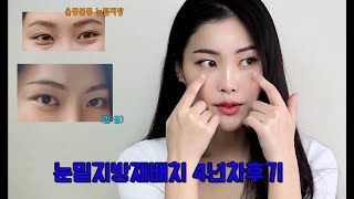 눈밑지방재배치 4년차 찐후기