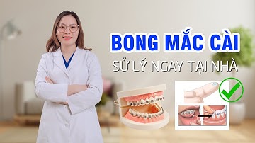 Làm Gì Khi Bạn Bị Bong Mắc Cài Tại Nhà