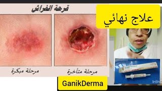 #دواء المعجزة #Ganikderma لعلاج#الجروح #قروح الفراش#المزمنة      # pour les soins d'escarres#