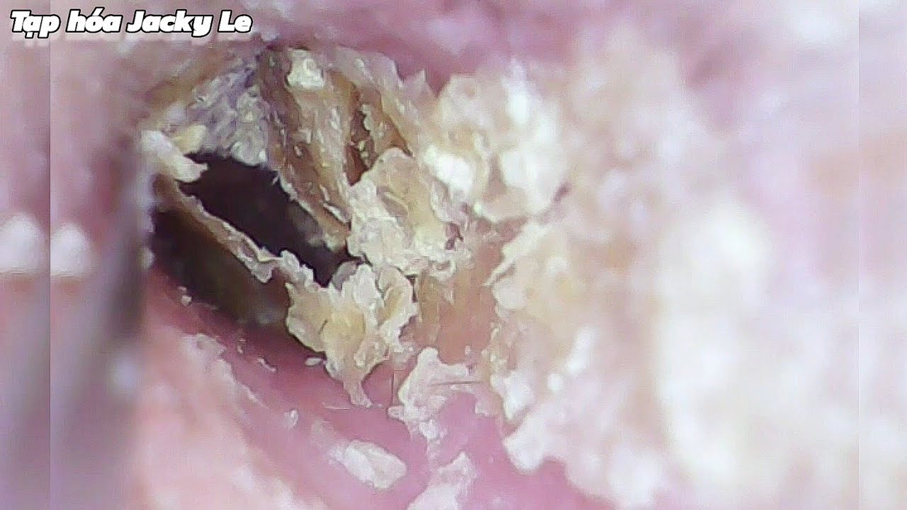 Ear Wax Removal 128: Dry and crumbly earwax causes itching | Ear Cleaning ASMR Relaxing Video