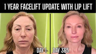 One Year FACELIFT Journey Update - WAS IT WORTH IT???