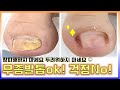 무좀발톱 걱정 놉! (No~~~) 오래된 무좀발톱도 문제없어요:) (thick toe nail)