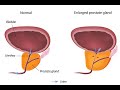 Dr shoaib mithani  prostrate problems in elderly males