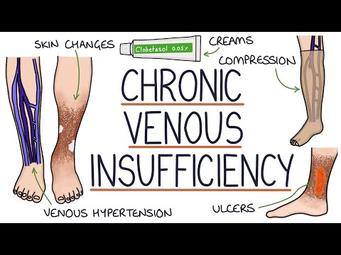 Video: Koks medicininis venų sąstingio terminas?