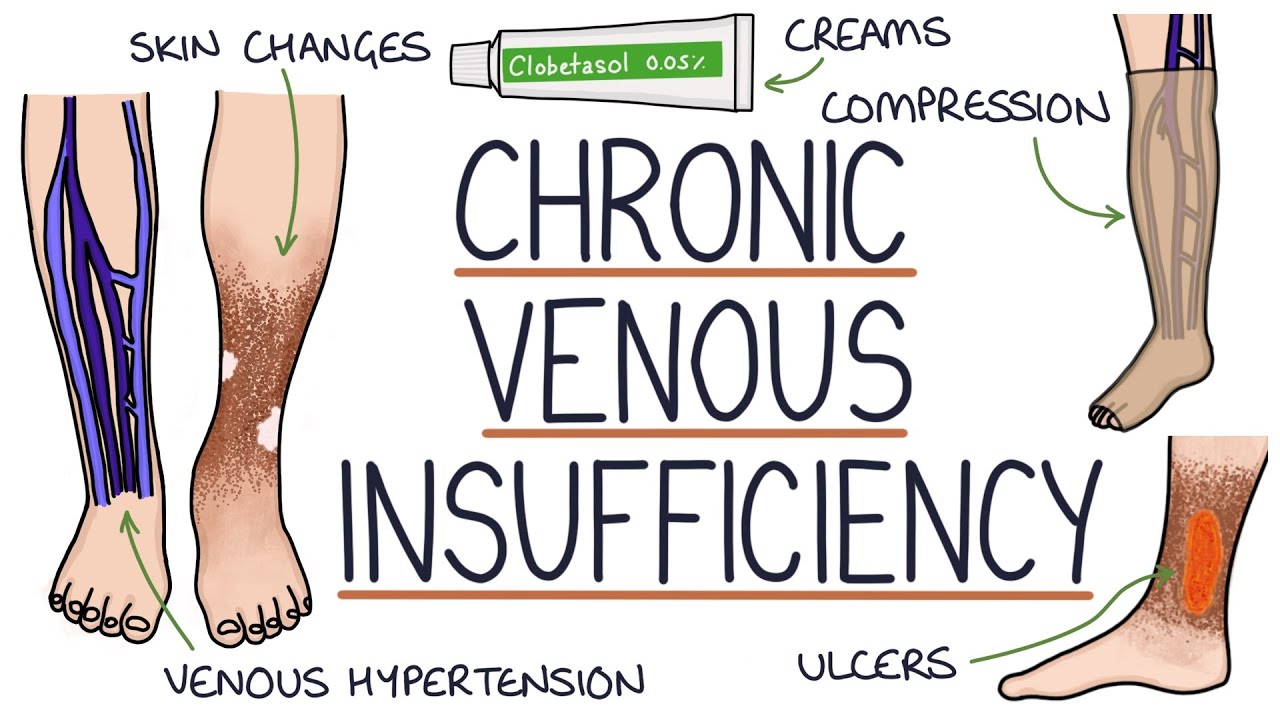 Understanding Chronic Venous Insufficiency Youtube