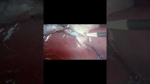 Dissection of Gall bladder 