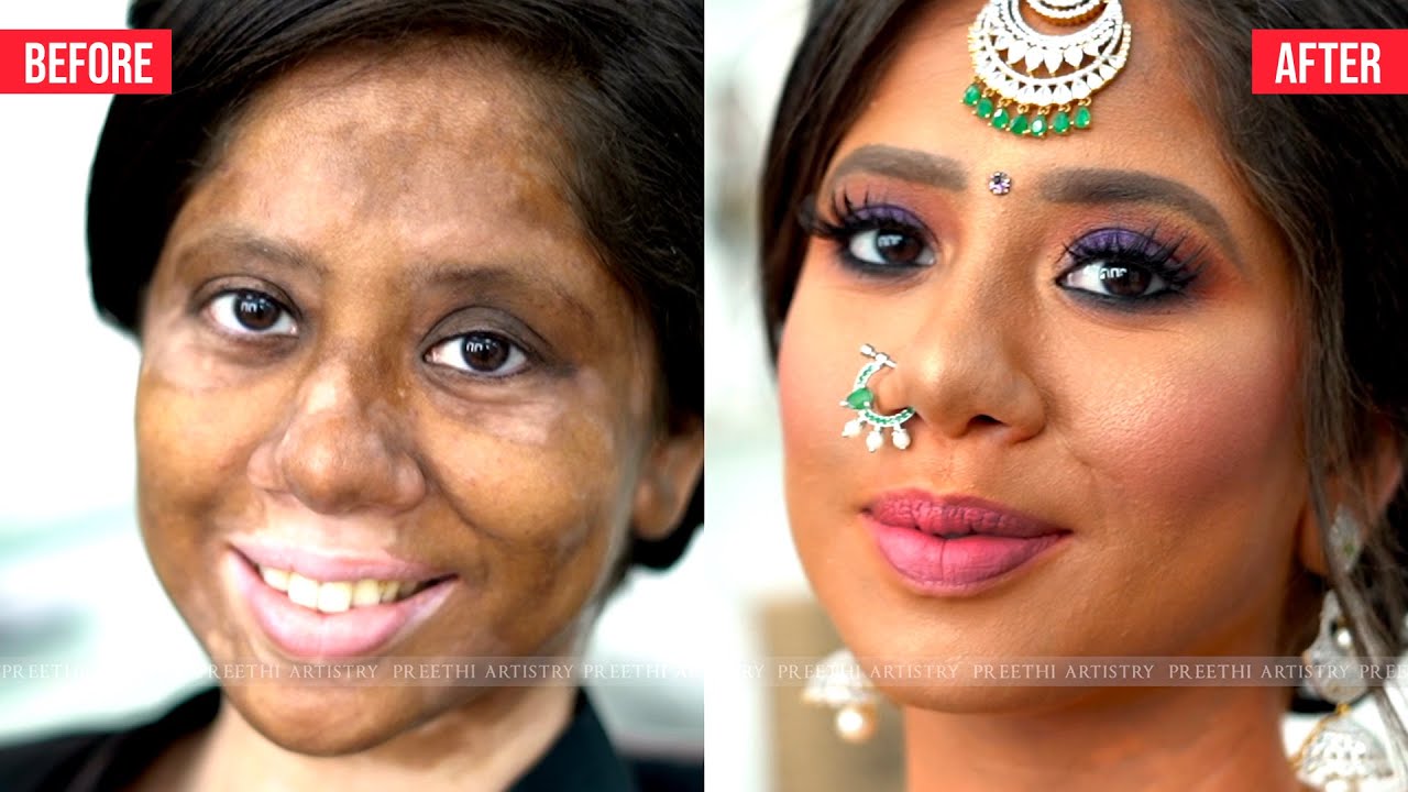 amatør Monetære offer Makeup for Vitiligo Skin | Makeup transformation | Preethi Artistry -  YouTube