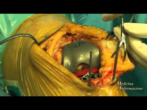 Protesi di Ginocchio: Chirurgia d&rsquo;Avanguardia con Protesi Antibiotate e Riabilitazione