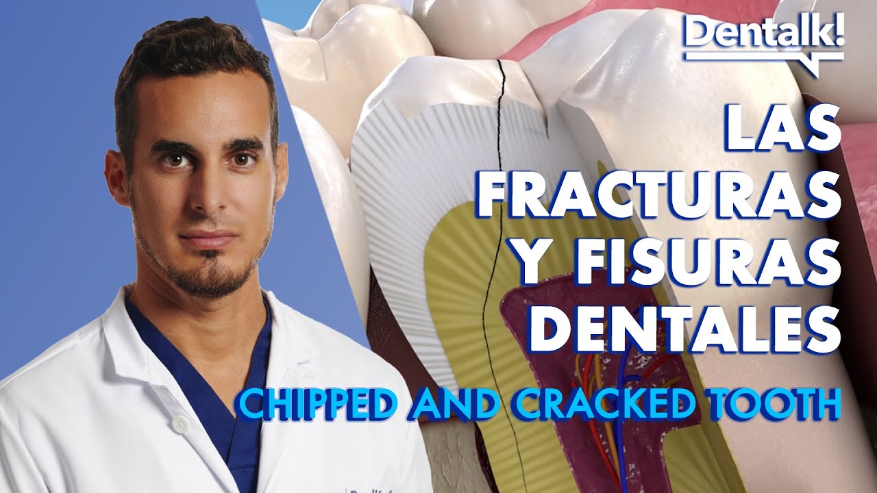 ¿Se te ha ROTO un DIENTE? Causas y cómo REPARAR una FRACTURA o FISURA dental | Dentalk! ©