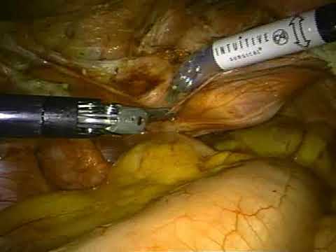 ✅ Ρομποτική Υστερεκτομή-Λαπαροσκοπική Υστερεκτομή  Robotic-Laparoscopic Hysterectomy