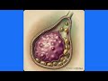 Gallbladder Fundal Mass with Gallstones on Ultrasound: Differential Diagnosis and Radiologic Clues
