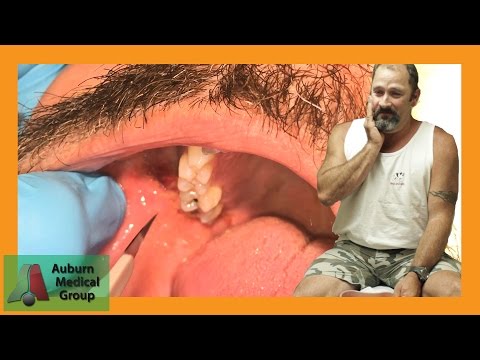 PAINFUL DENTAL ABSCESS DRAINED | Auburn Medical Group