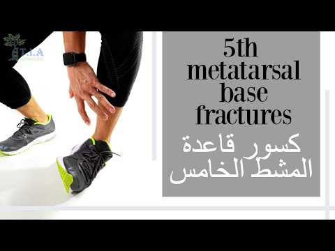 كسر قاعدة المشط الخامس    fifth metatarsal base fracture (subtitled)