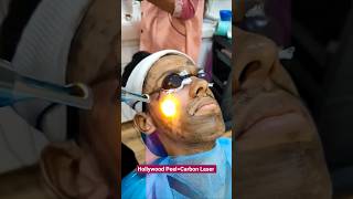Acne, Oil & Open Pores? Try Hollywood Peel