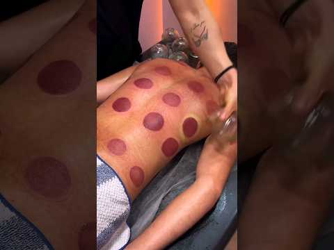 الحجامة الجافة Cupping الحجامة
