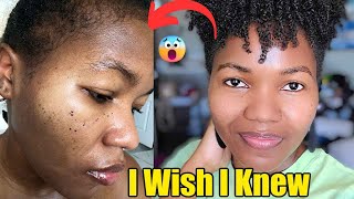 Tretinoin Destroyed My Skin &amp; How I fixed It | Tretinoin Before &amp; After