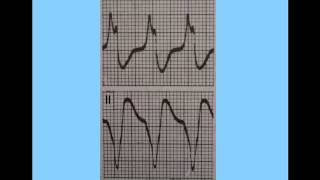 EMS ECG Reading | Beyond Lead II