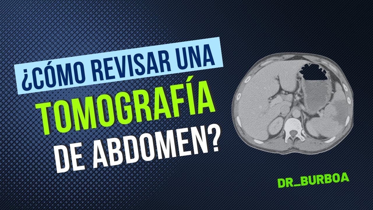 TOMOGRAFÍA DE ABDOMEN - ¿CÓMO REVISARLA?