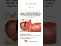 Immunology - Case 25