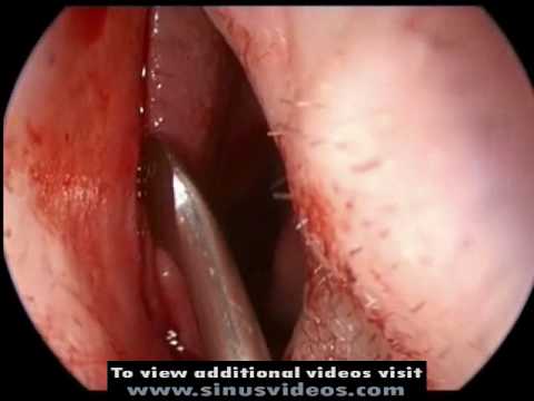 How is septoplasty surgery performed?