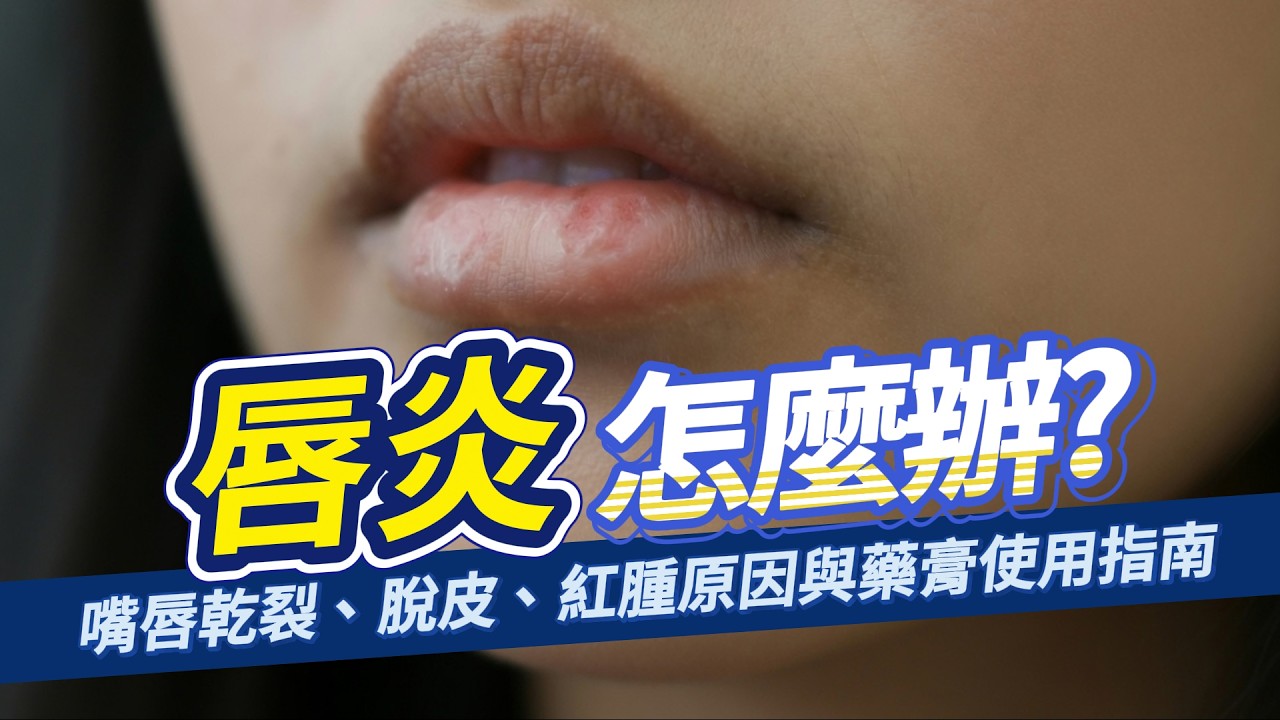 唇炎怎麼辦?嘴唇乾裂、脫皮、紅腫原因與藥膏使用指南 縮圖