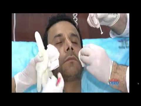 تقنية سيلفيل التحضيرالامن والسريع للصفائح الدموية بالبلازما